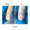 Nails Of The Day Olejek Przeciw Onycholizie Onistop 15 ml